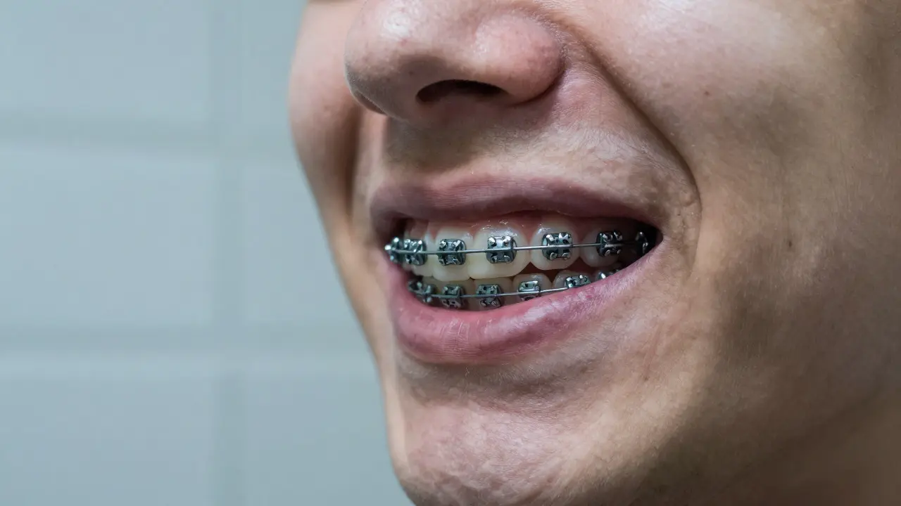 Jak se vyhnout bolesti při nošení fixních rovnátek: Praktický průvodce
